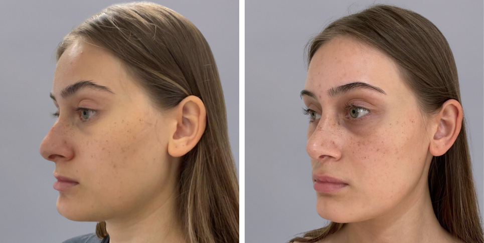 Rhinoplasty nose job before and after photo