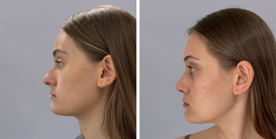 Rhinoplasty nose job before and after photo