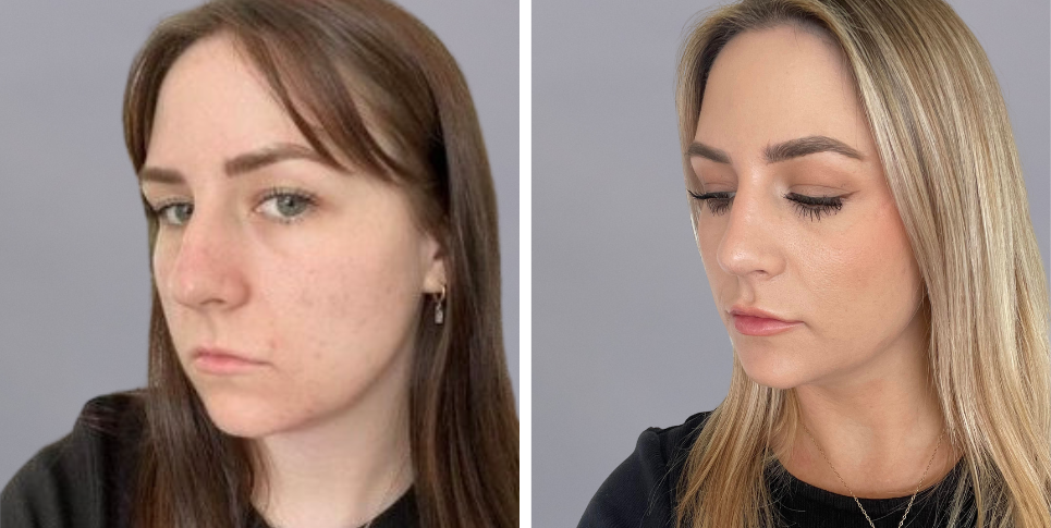 Rhinoplasty nose job before and after photo