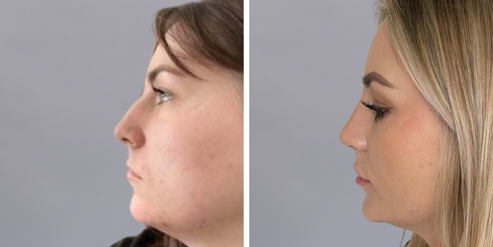 Rhinoplasty nose job before and after photo