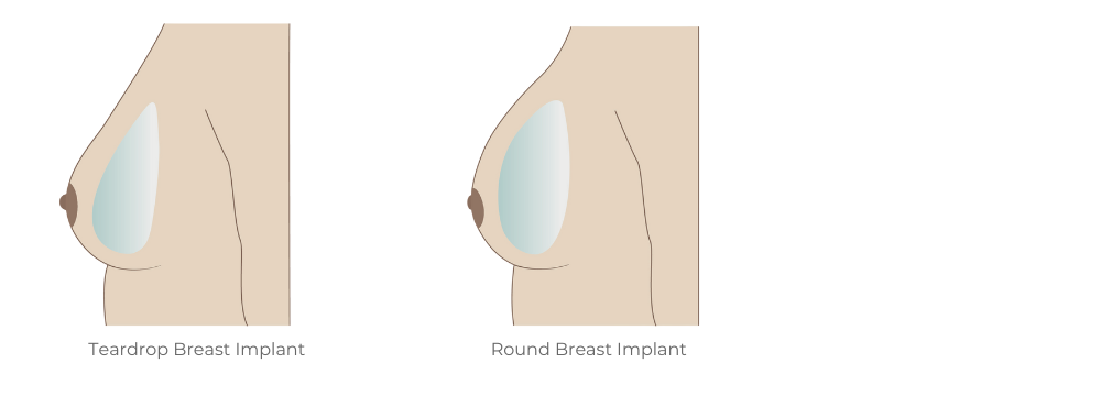 Compare Round Breast Implants with Teardrop breast Implants