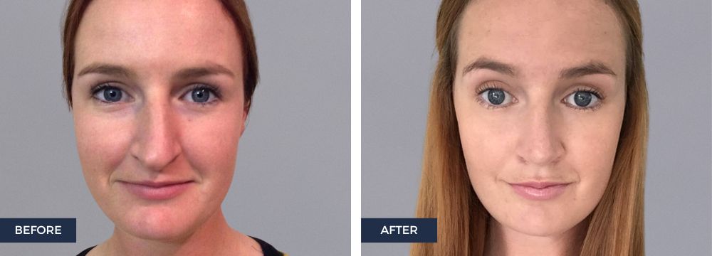 6 reasons you may consider a rhinoplasty, or a 'nose job'