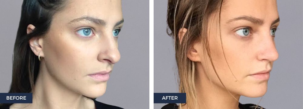 6 Reasons you may choose a rhinoplasty or a nose job for top refinement/ bulbous tip, flat tip, droopy tip, hanging columella