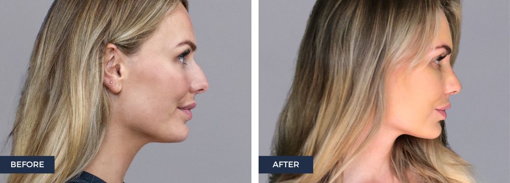 6 Reasons you may choose a rhinoplasty or a nose job dorsal hump removal, side profile hump removal 