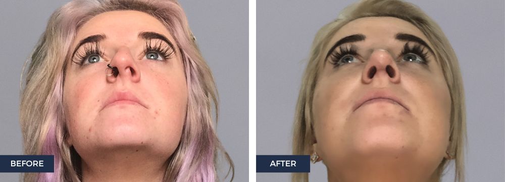 6 Reasons you may choose a rhinoplasty or a nose job deviated septum, breathing issues