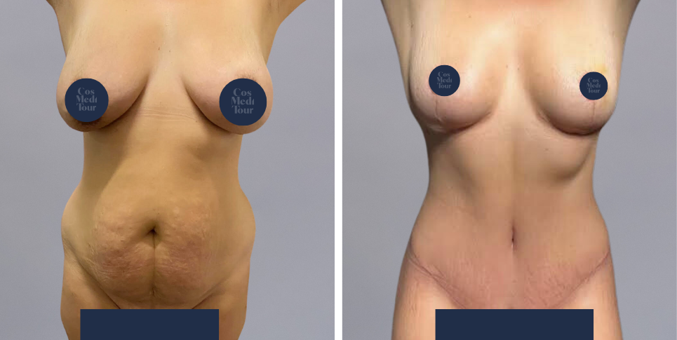 Mummy Makeover breast and abdomen combination before and after photo