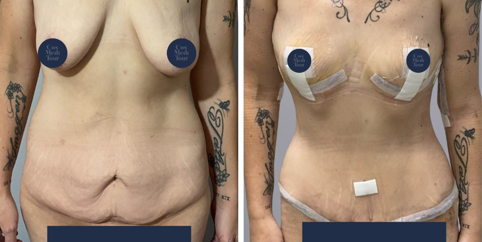 Mummy Makeover breast and abdomen combination before and after photo