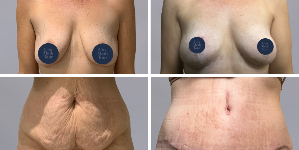 Mummy Makeover breast and abdomen combination before and after photo