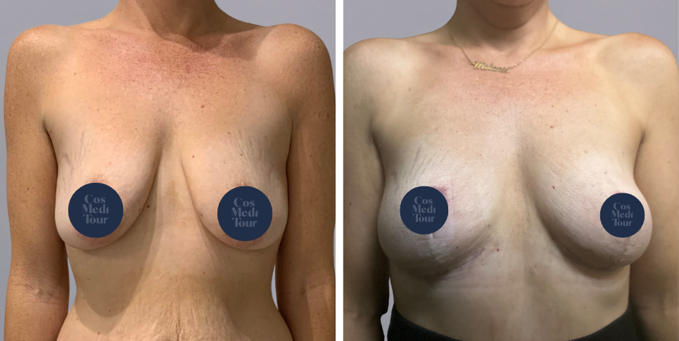 Mummy Makeover breast and abdomen combination before and after photo