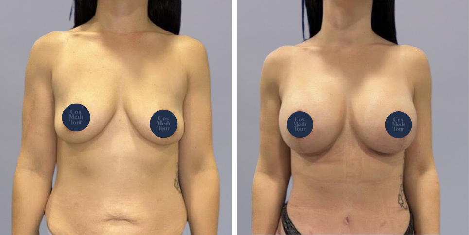 Mummy Makeover breast and abdomen combination before and after photo