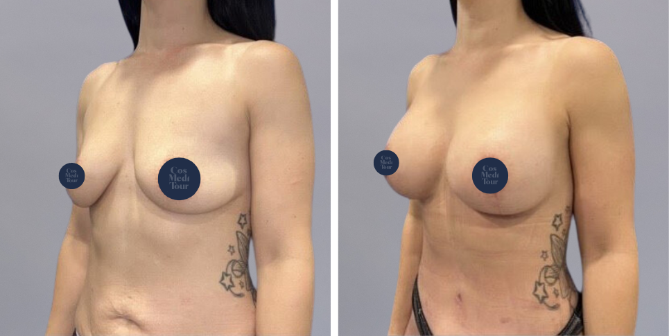 Mummy Makeover breast and abdomen combination before and after photo