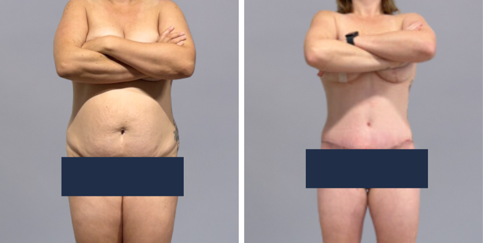 Mummy Makeover breast and abdomen combination before and after photo