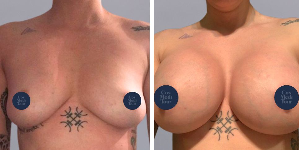 Breast Augmentation boob job before and after photo