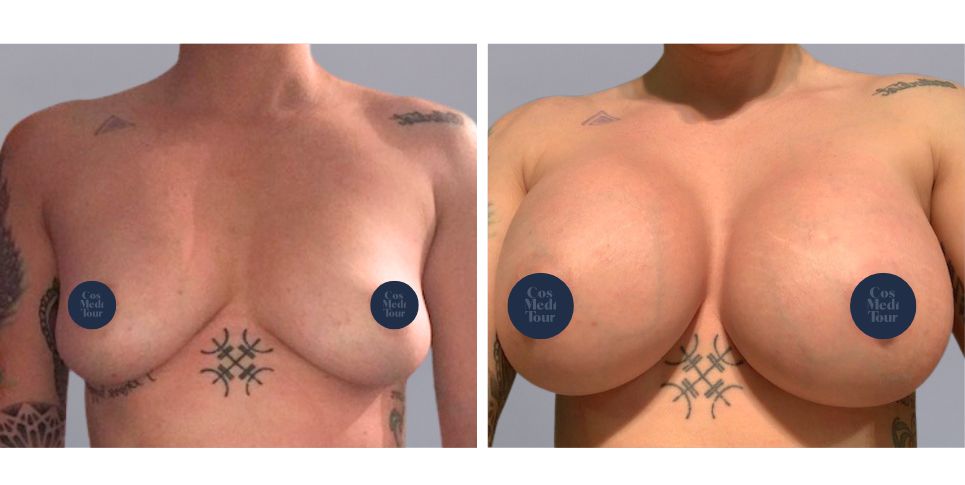 Breast Augmentation boob job before and after photo