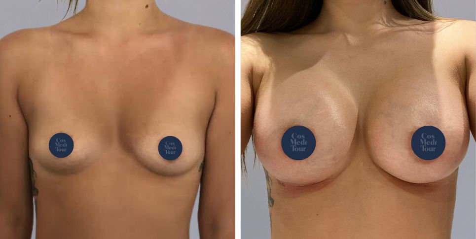 Breast Augmentation boob job before and after photo