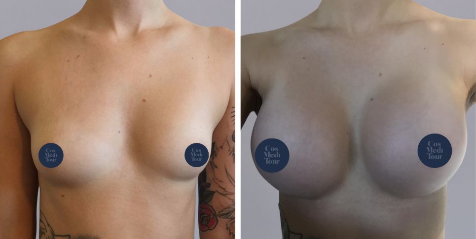 Breast Augmentation boob job before and after photo