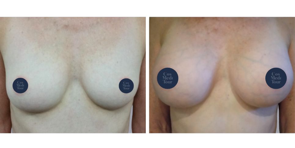 Breast Augmentation boob job before and after photo