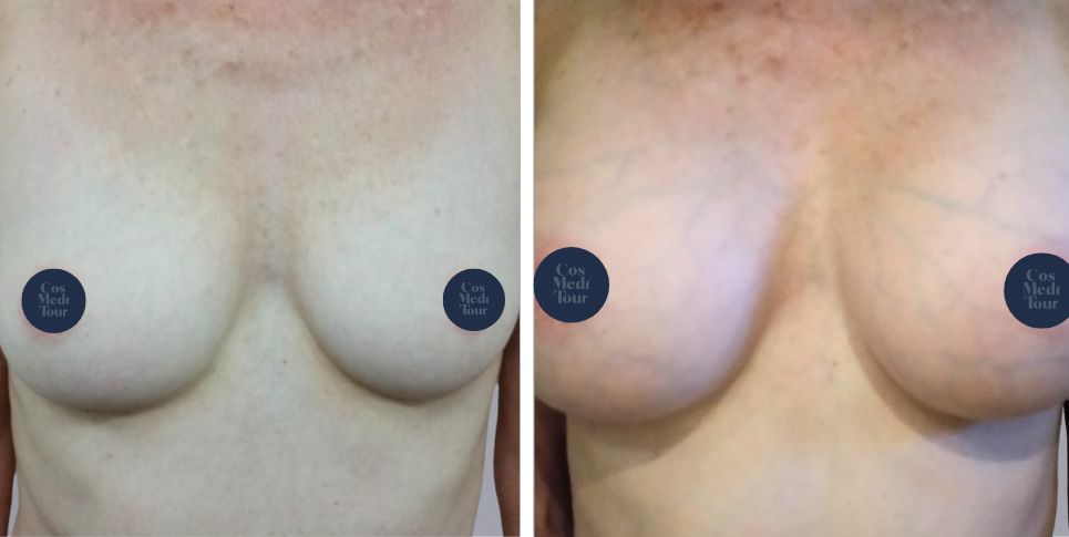 Breast Augmentation boob job before and after photo