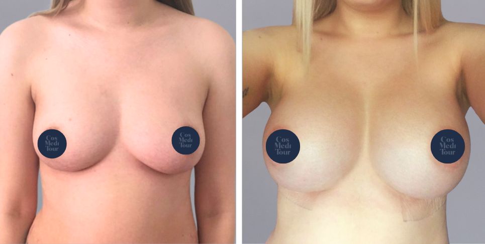 Breast Augmentation boob job before and after photo