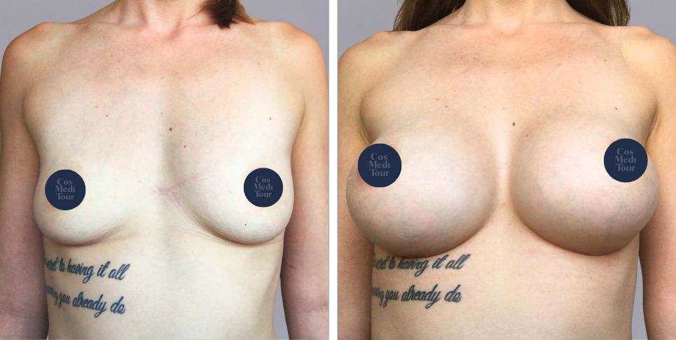 Breast Augmentation boob job before and after photo