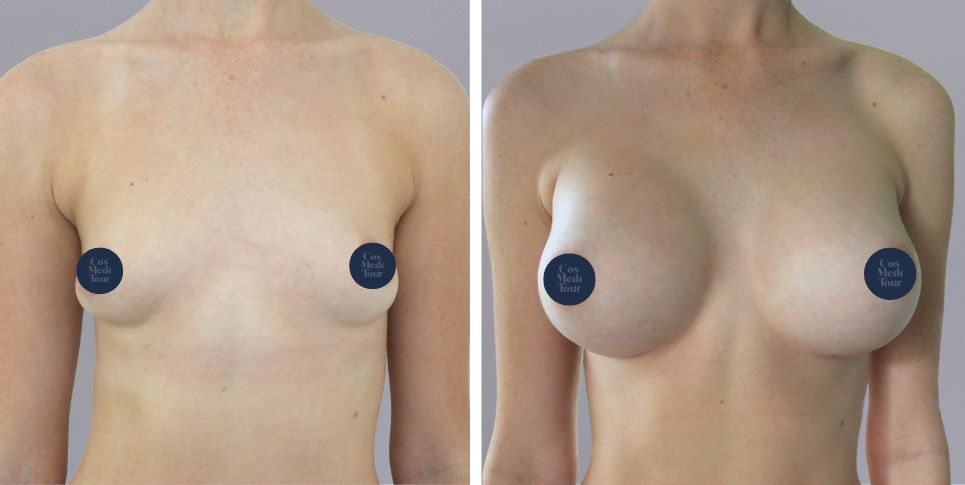 Breast Augmentation boob job before and after photo