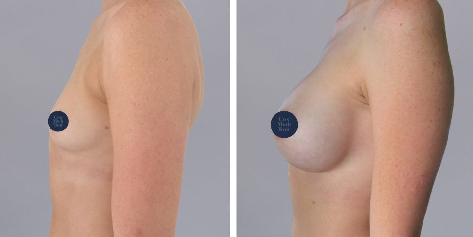 Breast Augmentation boob job before and after photo