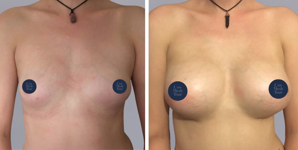 Breast Augmentation boob job before and after photo