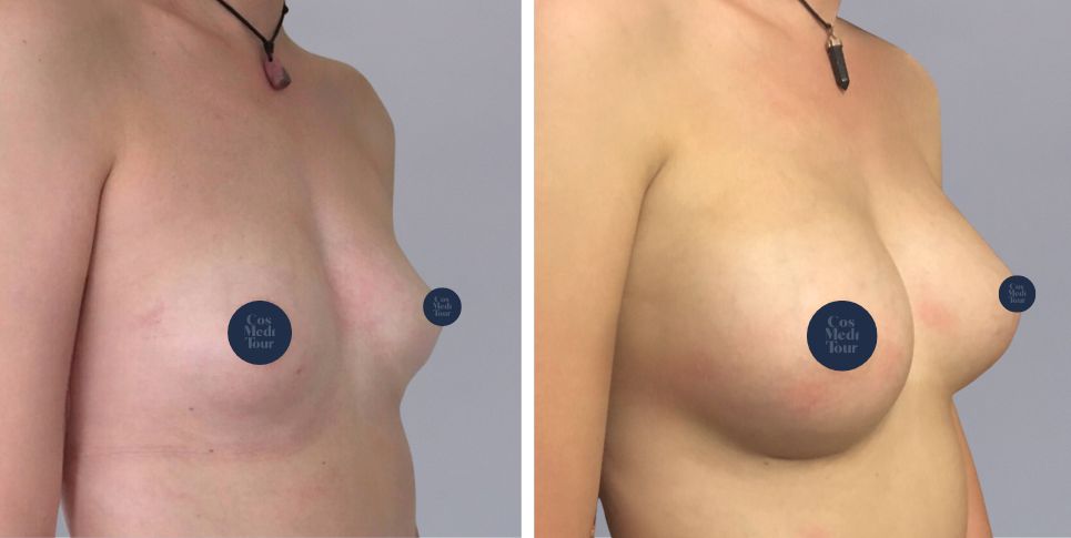 Breast Augmentation boob job before and after photo