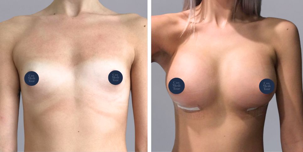 Breast Augmentation boob job before and after photo