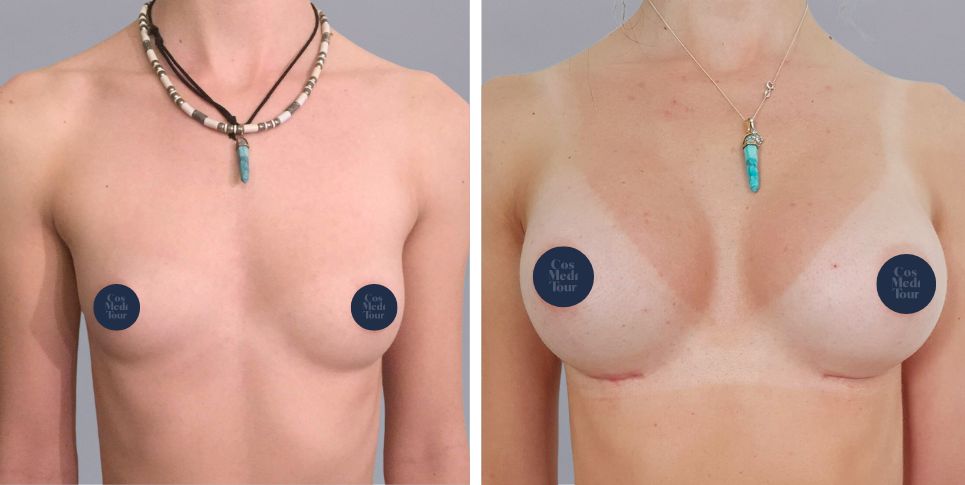 Breast Augmentation boob job before and after photo