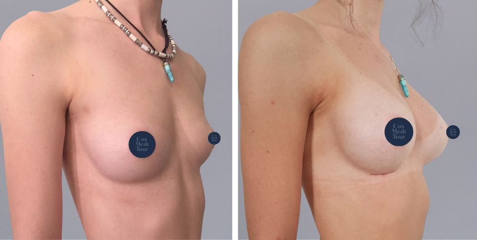 Breast Augmentation boob job before and after photo