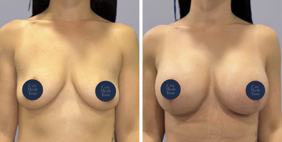 Breast Augmentation and breast lift breast augmentation plus lift boob job before and after photo