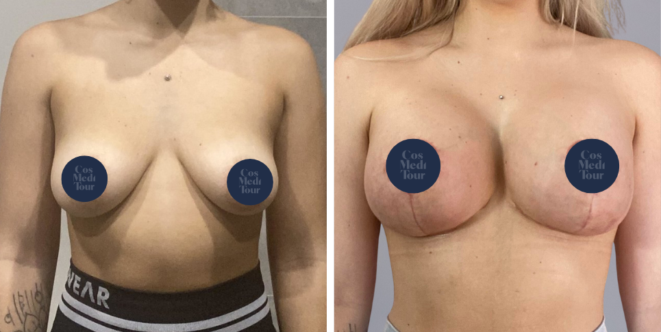 Breast Augmentation and breast lift breast augmentation plus lift boob job before and after photo