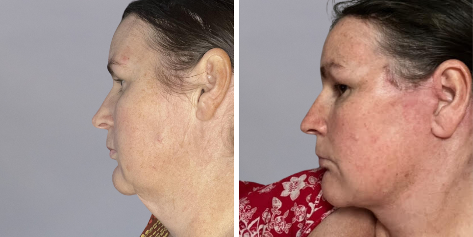 Face Lift Neck Lift before and after photo