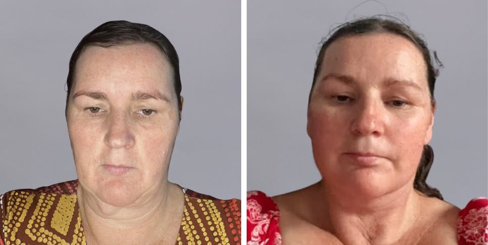 Face Lift Neck Lift before and after photo