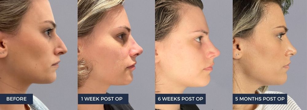 Client's Rhinoplasty/ Nose Job recovery of a 5 month period