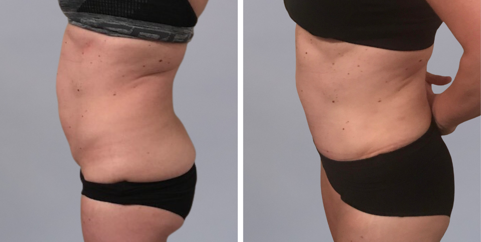 Tummy Tuck Abdominoplasty before and after photo