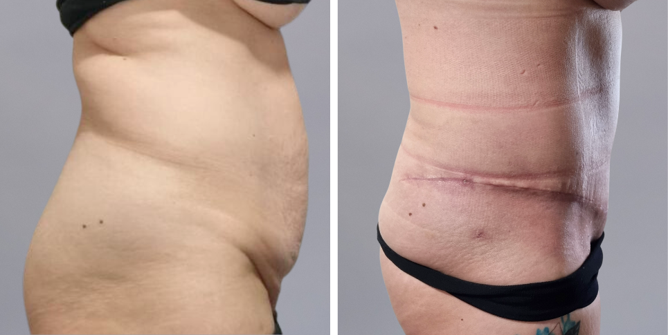 Tummy Tuck Abdominoplasty before and after photo