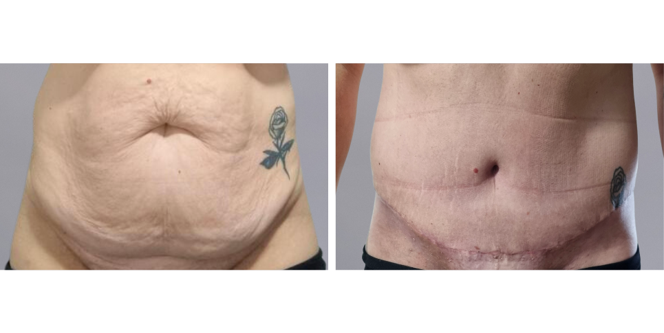 Tummy Tuck Abdominoplasty before and after photo