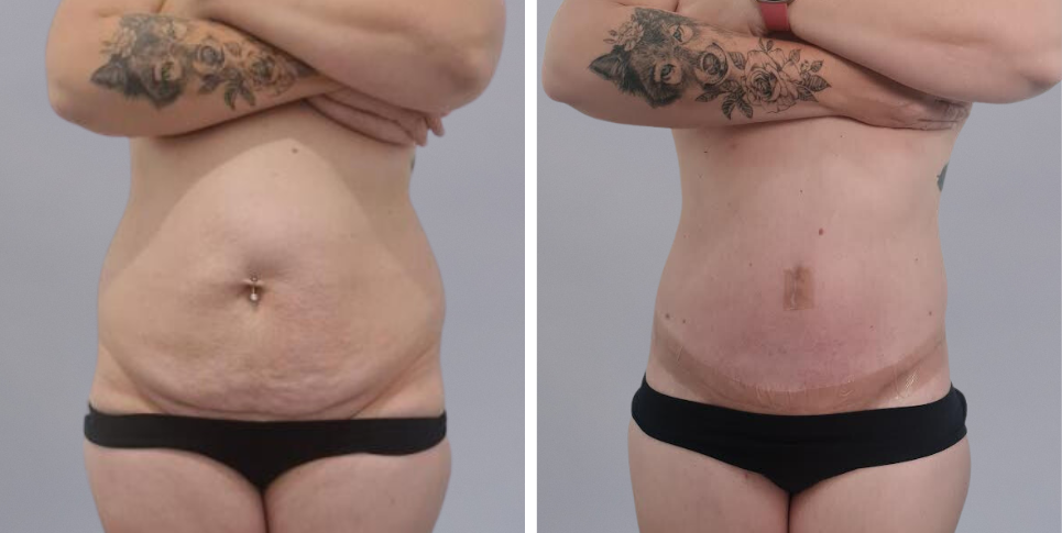 Tummy Tuck Abdominoplasty before and after photo