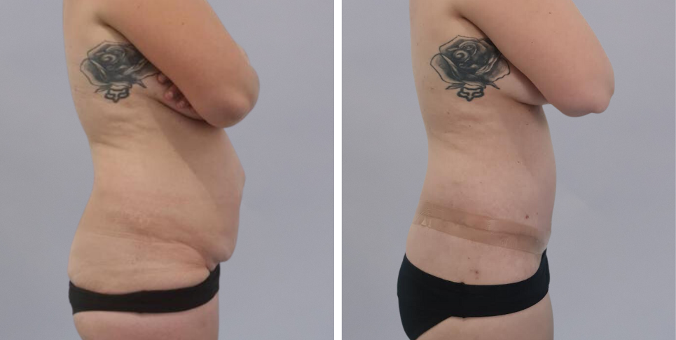 Tummy Tuck Abdominoplasty before and after photo