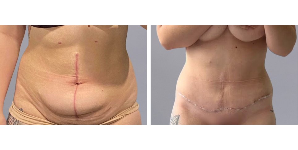 Tummy Tuck Abdominoplasty before and after photo