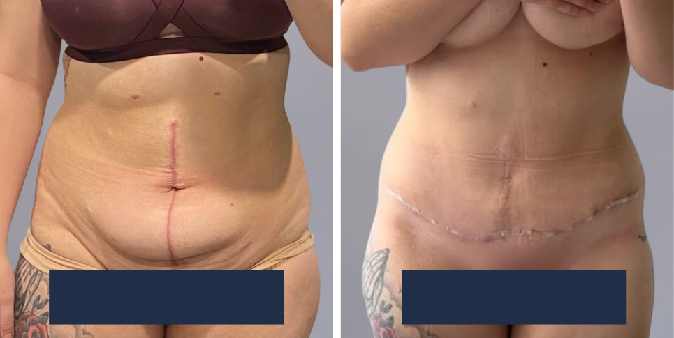Tummy Tuck Abdominoplasty before and after photo