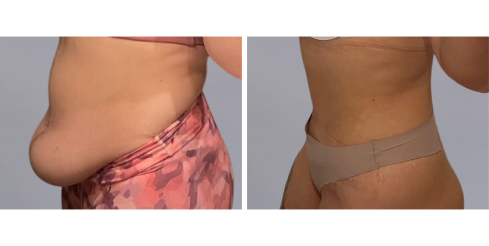 Tummy Tuck Abdominoplasty before and after photo