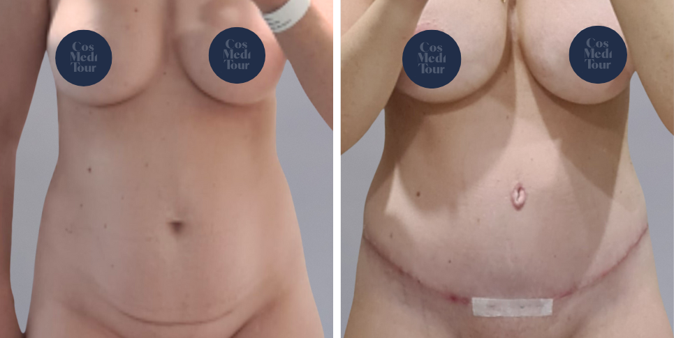 Tummy Tuck Abdominoplasty before and after photo