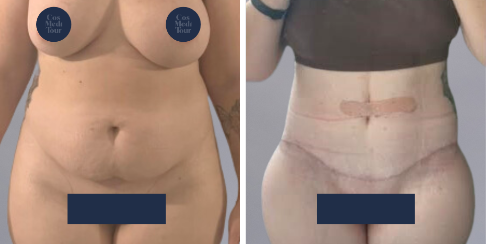 Tummy Tuck Abdominoplasty before and after photo