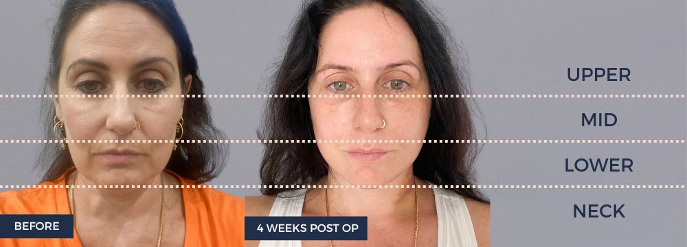 Woman facelift results, depicting upper facelift, mid facelift, lower facelift and neck lift. 