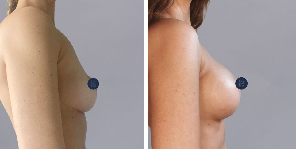 Breast Augmentation boob job before and after photo