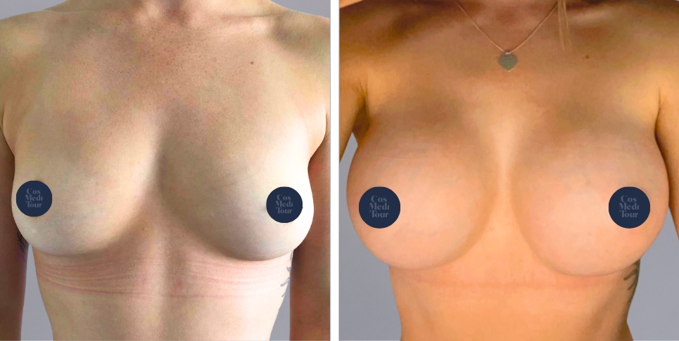 Breast Augmentation boob job before and after photo